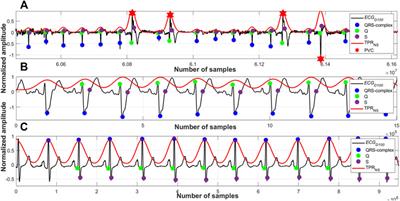 Robust Identification of the QRS-Complexes in Electrocardiogram Signals Using Ramanujan Filter Bank-Based Periodicity Estimation Technique